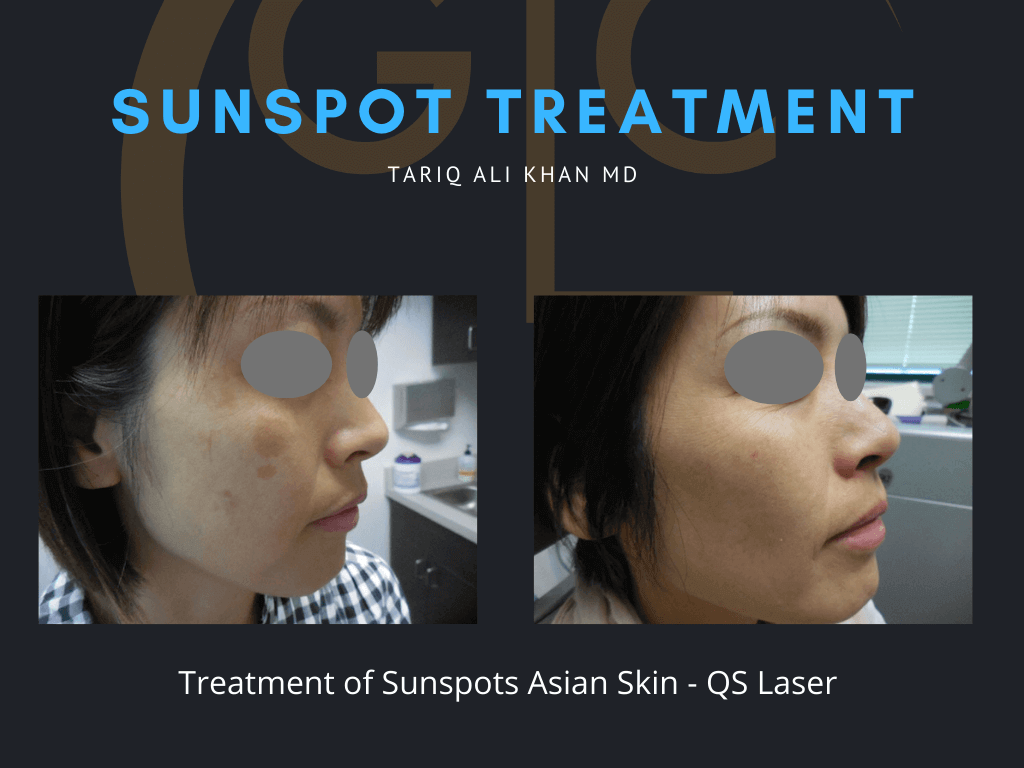 Gentle Care Laser Tustin Before and After picture - Sunspot treatment